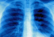 Vaccino peptidico raddoppia la sopravvivenza a 1 anno nel NSCLC in seconda linea