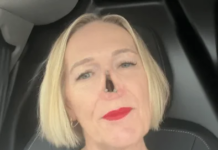 Granulomatosi con poliangioite: la storia di Jayne, costretta a vivere ‘senza naso’